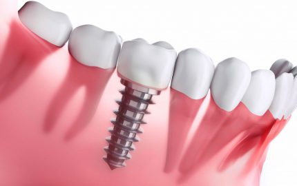 Diş İmplantı Tedavisi Hangi Aşamalardan Oluşur