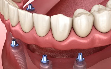 implant tedavisi nasıl yapılır