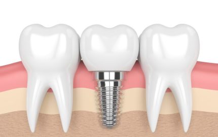 implant-tedavisi-nasil-uygulanir