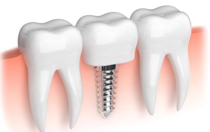 implant-yaptiranlar-nelere-dikkat-etmeli